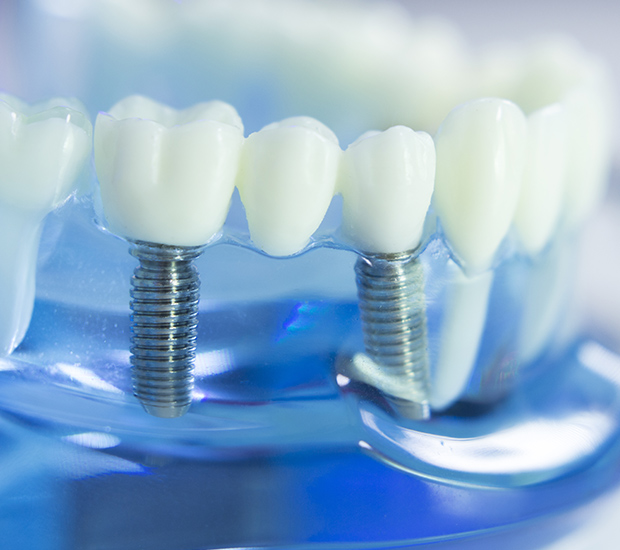 Tustin Dental Implants