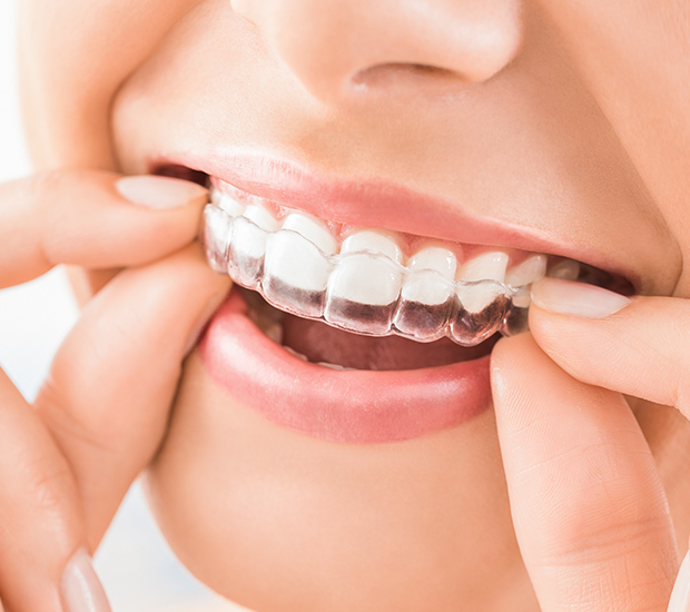 Tustin Does Invisalign Really Work